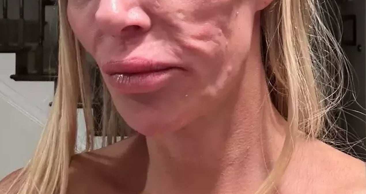 Ünlü oyuncunun yüzünü parazitler sardı! Aynada kendini tanıyamıyor